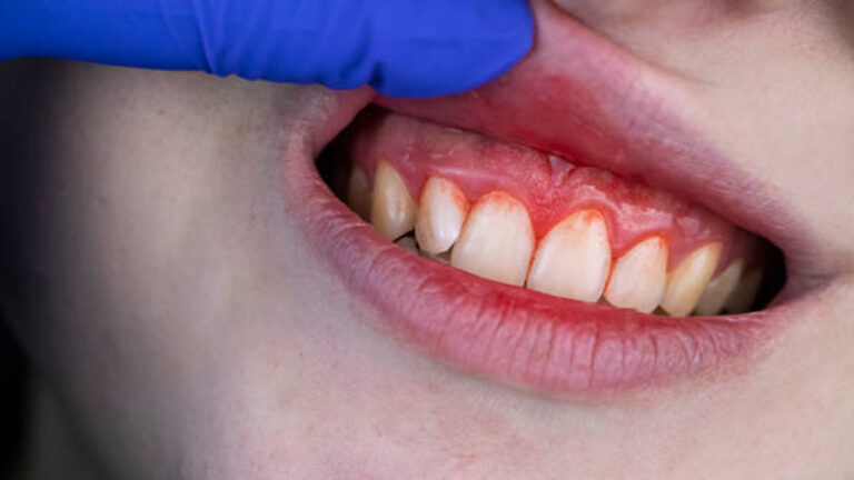 ब्रश करते समय कहीं आपके दांतों से भी तो नहीं आ रहा खून खतरनाक बीमारी के हैं लक्षण